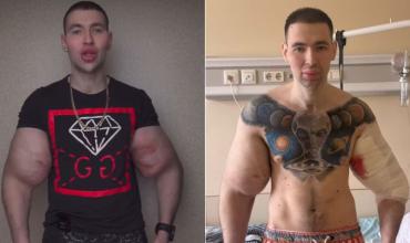 Un influencer se inyectó vaselina en los bíceps para parecerse a “Popeye” y ahora podría perder ambos brazos