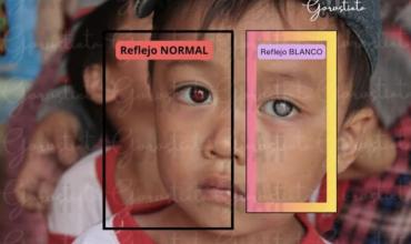 Retinoblastoma: el cáncer ocular infantil que puede detectarse a tiempo