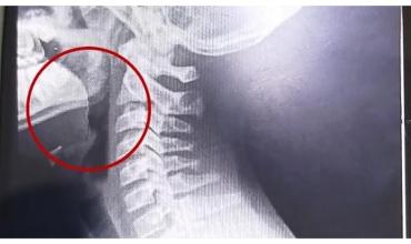 Comió una galletita y comenzó a escupir sangre: el sorprendente hallazgo que hicieron los médicos en su garganta