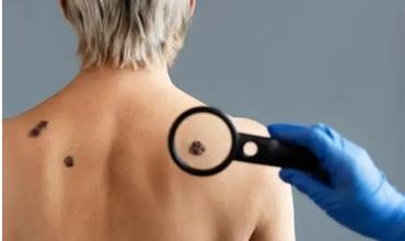 Cáncer de piel: cómo prevenir la enfermedad más frecuente y tratable si se detecta a tiempo