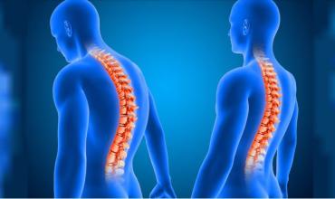 Escoliosis: el deporte y los chequeos como pilares del desarrollo saludable de niños y adolescentes