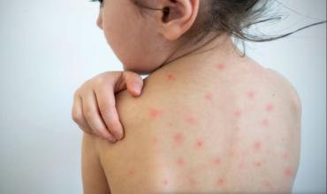 Casos de sarampión en Estados Unidos alcanzan su nivel más alto en 35 años