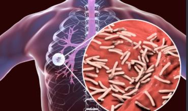 Tuberculosis: un infectólogo advirtió que la enfermedad sigue vigente y pidió estar atentos a los síntomas
