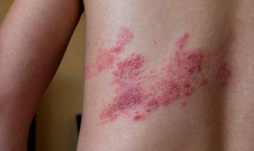Una nueva vacuna contra el Herpes Zóster (Culebrilla)  está disponible en Argentina