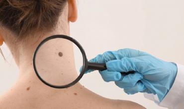 Día Mundial del Melanoma: concientización y prevención del cáncer de piel más agresivo