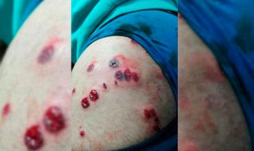 Chilecito: intentó escapar un control policial y fue herido con 11 balas de goma