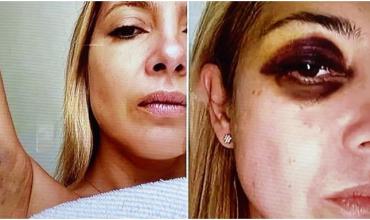 Fabiola Yañez ratificó que Alberto Fernández la golpeó: “Ese ojo morado existió”