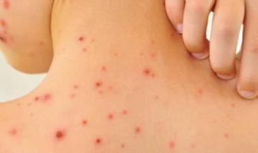 El sarampión reaviva alertas sanitarias en México, Estados Unidos y Canadá