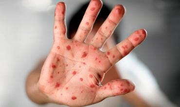 Se registraron 4 nuevos casos de Mpox y ya suman 15 en el año