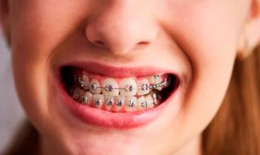 La ANMAT prohibió la venta de brackets por riesgo a la salud